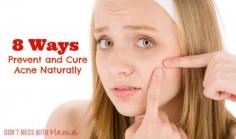 
                        
                            8 Ways to Prevent and Cure Acne Naturally - Don't Mess with Mama.com
                        
                    