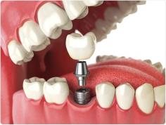 Dental Implants – The Best Way to Get Teeth Replacement

‘Never regret anything that makes you smile’. Dental Care plays a very important part of our daily hygiene and it is very much necessary to look after it as it not only improves your overall personality and appearance but also creates a positive vibe for yourself and to others.