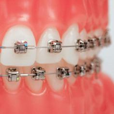 A combination of upper lingual and lower ceramic braces is another popular option among patients especially with financial concerns.

