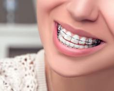 Ceramic Braces

There are many orthodontic treatments like Invisalign, clear aligners, dental implants that help to straighten one’s teeth which beautifies your smile. But getting braces can be quite apprehensive.