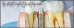 Is dental implants good for?

Invisible Braces clinic is the best dental clinic in Mumbai for helping you make the right choice. Our dentists will provide you with many cosmetic dentistry options for different teeth issues. But the only and the best dental treatment for repairing tooth loss is dental implants.