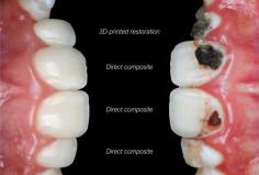 Composite restoration is a dental procedure used to repair decayed, chipped, or damaged teeth. Using tooth-colored materials, it blends seamlessly with your natural teeth, restoring both function and appearance. It's a quick and minimally invasive way to achieve a confident, healthy smile. Contact Smile Studio today at 919-518-0400 to schedule your consultati